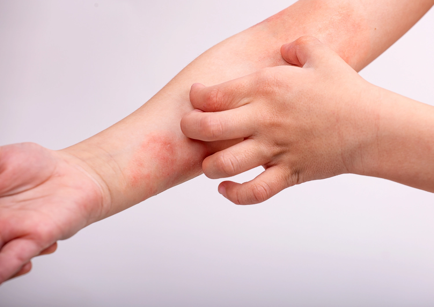 Lázně pro děti s atopickým ekzémem