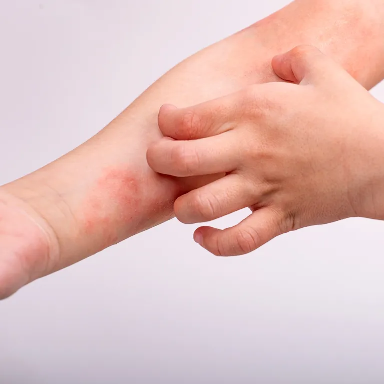 Lázně pro děti s atopickým ekzémem